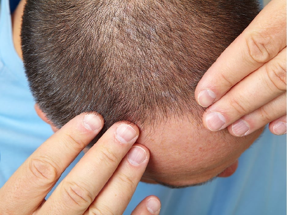What should be considered after hair transplantation?